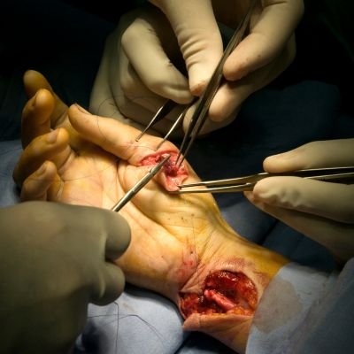 Injertos o colgajos microquirúrgicos en cirugía reconstructiva