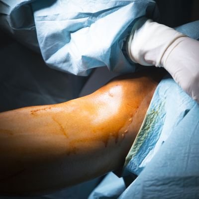 Lesiones vasculares extremidades