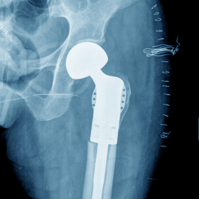 Prótesis de cadera o rodilla